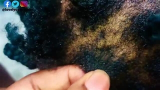 شامپو های ضد شپش خارجی