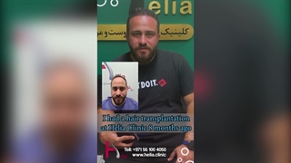 8 months after hair transplantation the result that will astonish you