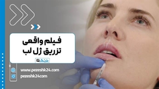 فیلم واقعی تزریق ژل لب