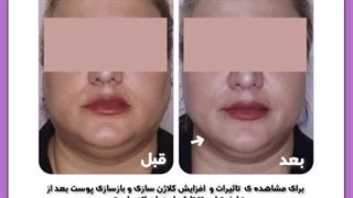 از بین بردن غبغب با هایفو توسط دکتر علیزاده در تهران