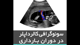 سونوگرافی کالرداپلر در دوران بارداری