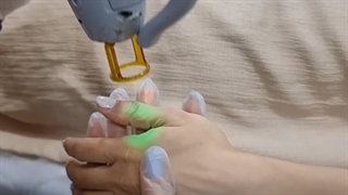 لیزر کندلا الکس در فردیس